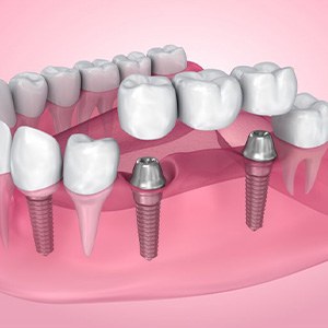 Illustration of implant bridge