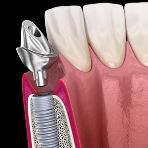 A 3D illustration of a placed dental implant and its abutment