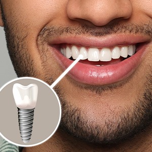 A photo highlighting a man’s front tooth dental implant