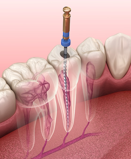 Illustration of tooth being removed with forceps