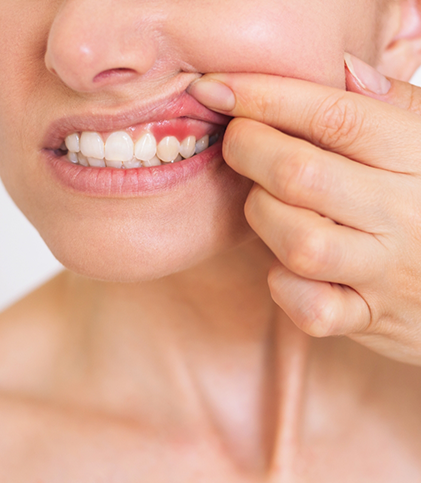 Pulling up lip to show inflamed gums