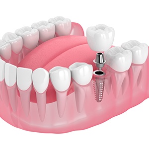 Illustration of dental implant