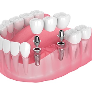 Illustration of implant bridge