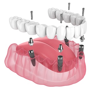 Illustration of implant denture