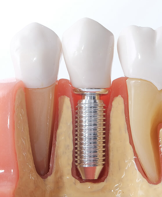 Model of a dental implant in Cambridge