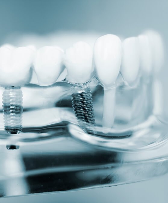 Dental implants in Cambridge in plastic tray with models of teeth